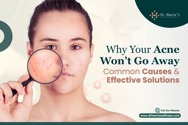 Why Your Acne Won’t Go Away: Common Causes & Effective Solutions – @drharorswellnessgk on Tumblr